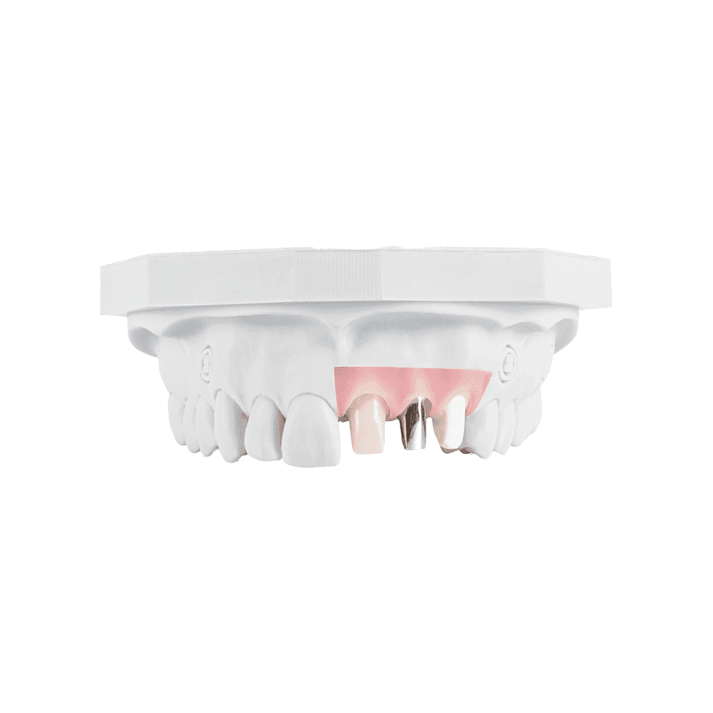 Custom Abutments gallery image 1