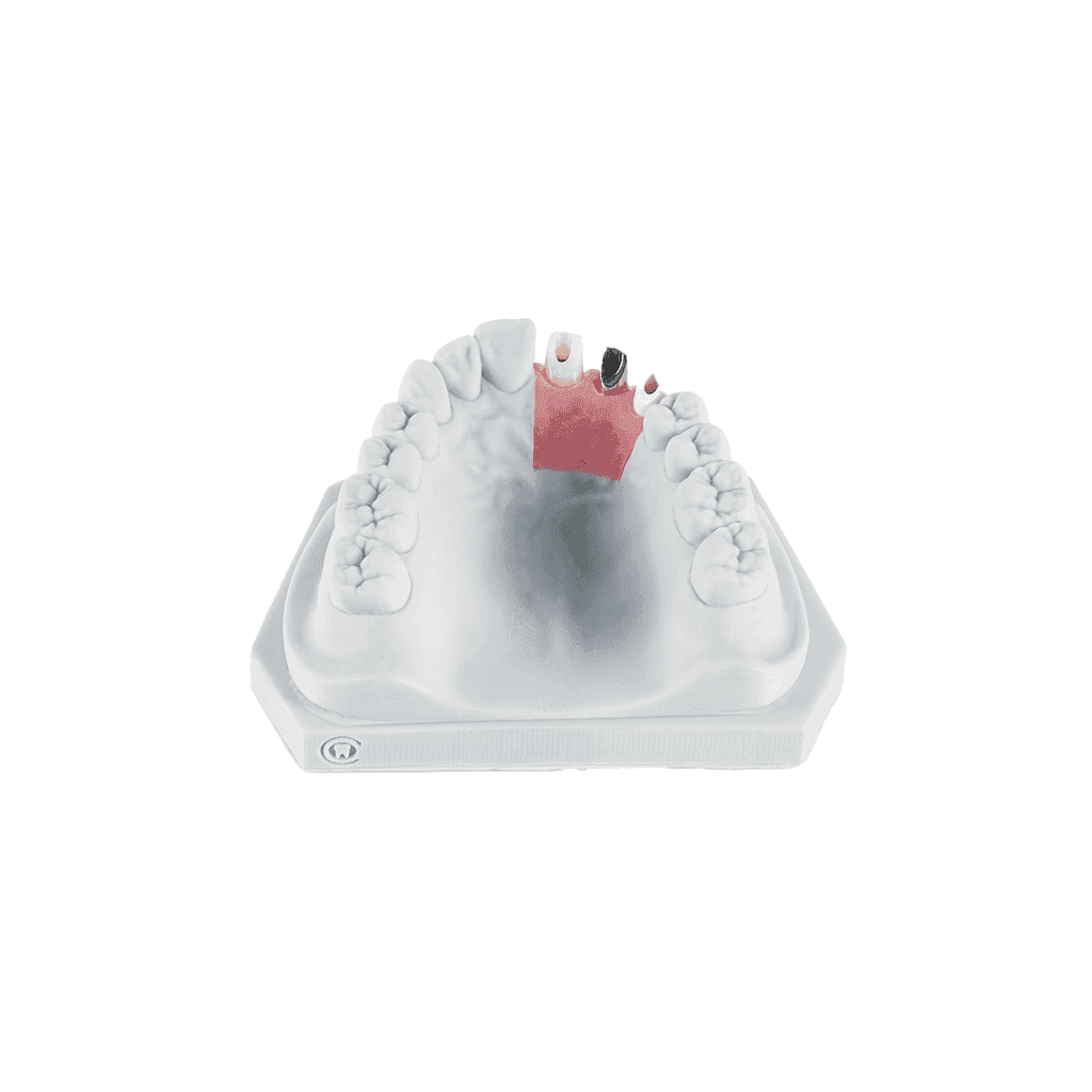 Custom Abutments gallery image 4