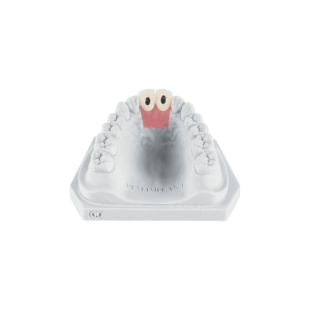 Screw-Retained gallery image 4